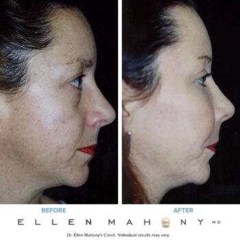 facial augmentation