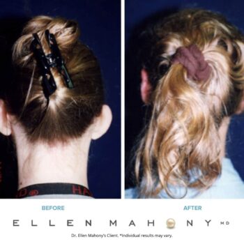 Ear Pinning | Westport CT | Dr. Ellen Mahony