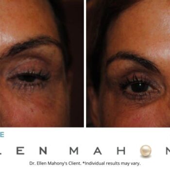 Eyelid Surgery | Westport CT | Dr. Ellen Mahony