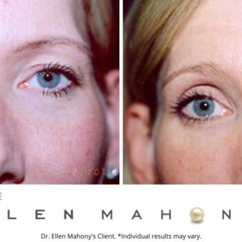 Eyelid Surgery | Westport CT | Dr. Ellen Mahony