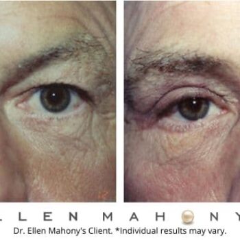 Eyelid Surgery for Men Westport CT | Dr. Ellen Mahony