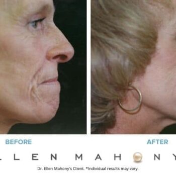 Skin Resurfacing | Westport CT | Dr. Ellen Mahony