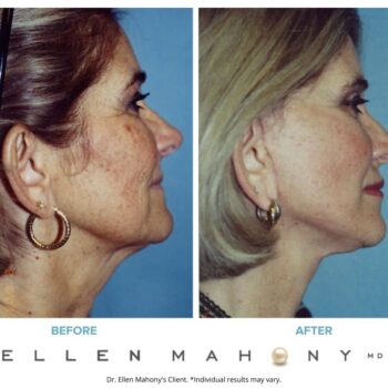 Skin Resurfacing | Westport CT | Dr. Ellen Mahony