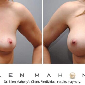 Breast Augmentation | Westport CT | Dr. Ellen Mahony
