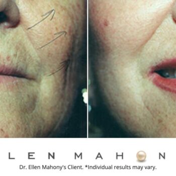 Lip Augmentation | Westport CT | Dr. Ellen Mahony