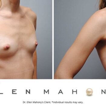 Breast Augmentation | Westport CT | Dr. Ellen Mahony