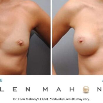 Breast Augmentation | Westport CT | Dr. Ellen Mahony