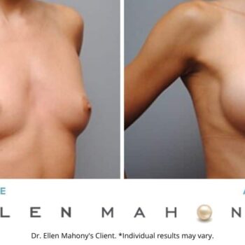 Breast Augmentation | Westport CT | Dr. Ellen Mahony