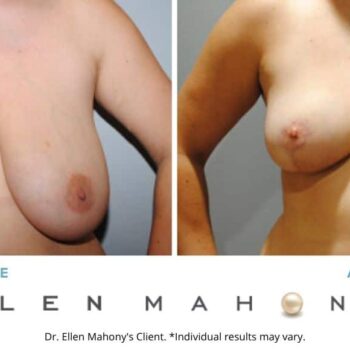 Breast Reduction | Westport CT | Dr. Ellen Mahony