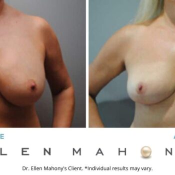 Corrective Breast Surgeon Westport CT