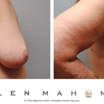 Breast Reduction | Westport CT | Dr. Ellen Mahony