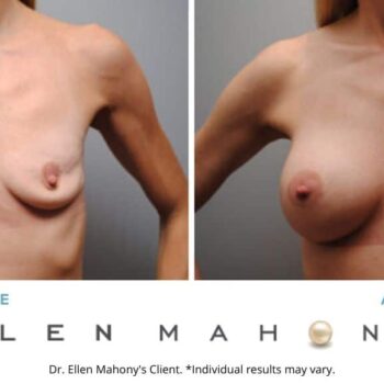 Breast Augmentation | Westport CT | Dr. Ellen Mahony