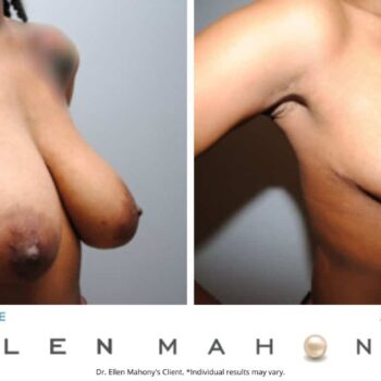 Breast Reduction | Westport CT | Dr. Ellen Mahony