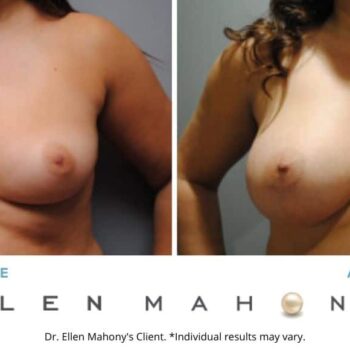 Breast Augmentation | Westport CT | Dr. Ellen Mahony