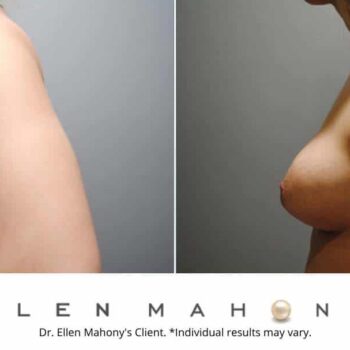 Corrective Breast Surgery | Westport CT | Dr. Ellen Mahony