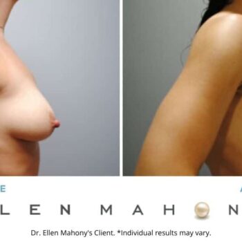 Breast Augmentation | Westport CT | Dr. Ellen Mahony