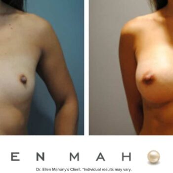 Breast Augmentation | Westport CT | Dr. Ellen Mahony