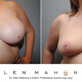 Breast Reduction | Westport CT | Dr. Ellen Mahony