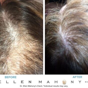 PRP Hair Restoration Case | Westport CT | Dr. Ellen Mahony