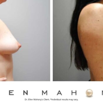 Breast Lift | Westport CT | Dr. Ellen Mahony