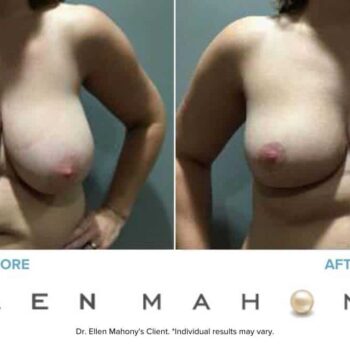 Breast Reduction | Westport CT | Dr. Ellen Mahony
