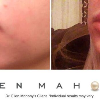 Lip Augmentation | Westport CT | Dr. Ellen Mahony