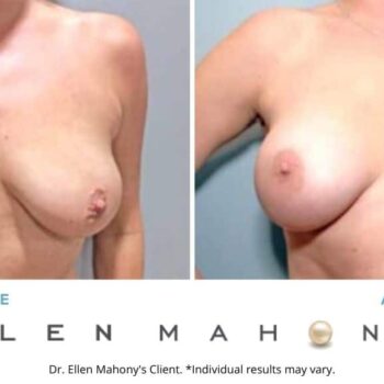 Breast Augmentation | Westport CT | Dr. Ellen Mahony