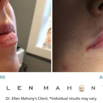 Injectable Fillers Before & After Images Westport CT