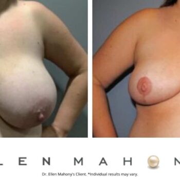 Breast Reduction | Westport CT | Dr. Ellen Mahony