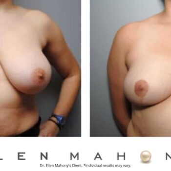 Breast Reduction | Westport CT | Dr. Ellen Mahony
