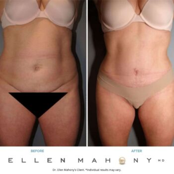 Liposuction Westport CT | Dr. Ellen Mahony