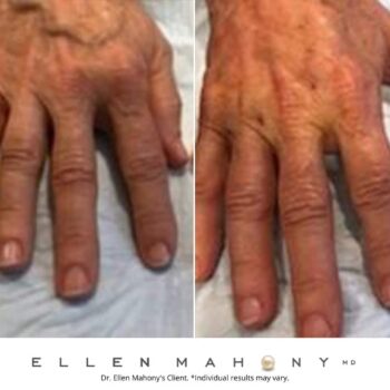 ALMI/Microfat Transfer Treatment Fairfield County CT