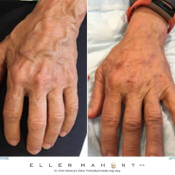 ALMI Procedures | Westport CT | Dr. Ellen Mahony Case #8375