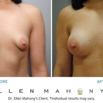 Corrective Breast Surgery | Westport CT | Dr. Ellen Mahony
