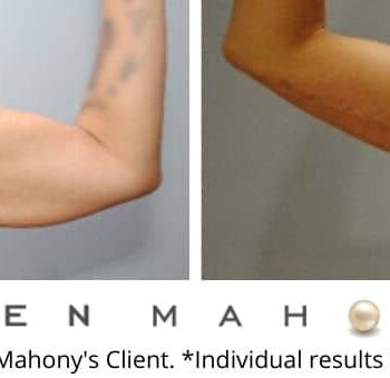 Body Lift/Brachioplasty Westport CT | Dr. Ellen Mahony