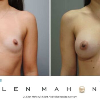 IDEAL Breast Implants | Breast Augmentation | Westport CT | Dr. Ellen Mahony