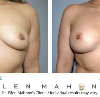 IDEAL Breast Implants | Westport CT | Dr. Ellen Mahony