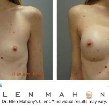 Breast Augmentation | Westport CT | Dr. Ellen Mahony