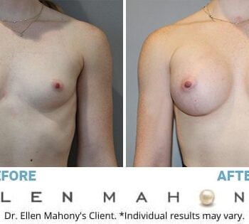 Breast Procedures 